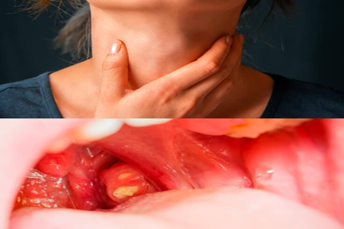 چطور سنگ لوزه را برطرف کنیم؟